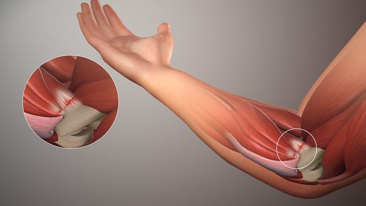 Vos douleurs au coude pendant les tractions peuvent venir d'un tennis ou golf elbow